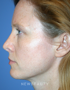 Dr. Kelly Bomer, Rhinoplasty - After