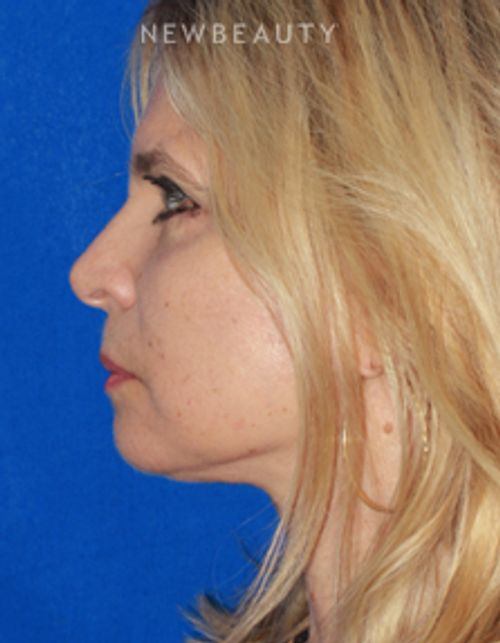 Dr. Konstantin Vasyukevich - Upper and Lower Blepharoplasties - After