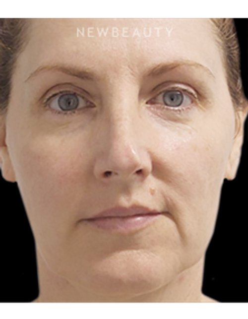 Dr. Marina Peredo - Nonsurgical Lifting and Tightening - Before