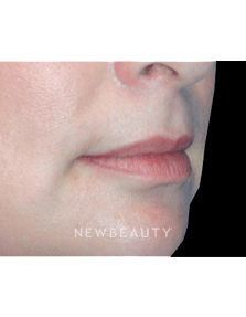 Dr. Kelly Bomer Lip Augmentation - Before