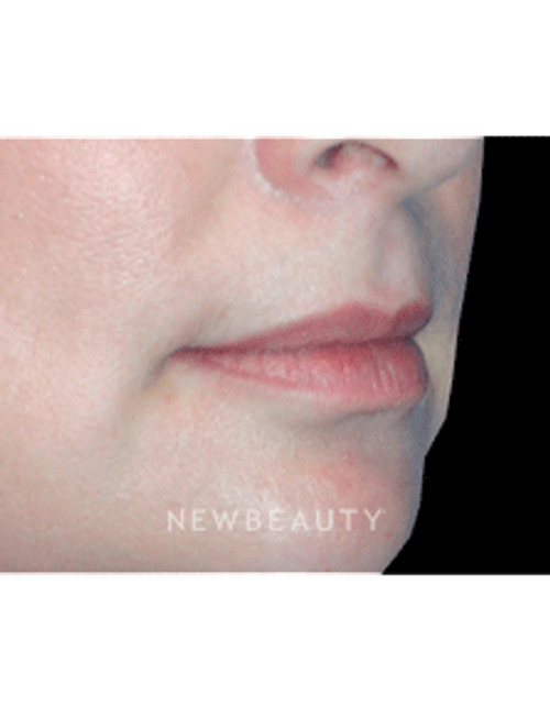 Dr. Kelly Bomer Lip Augmentation - Before