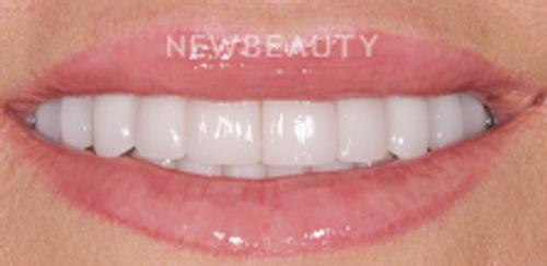 Dr. Salvator La Mastra - Smile Makeover- 46106595 - After