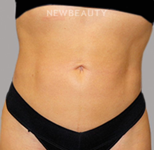 Dr. Sanjay Grover - Liposuction - 49728009 - After