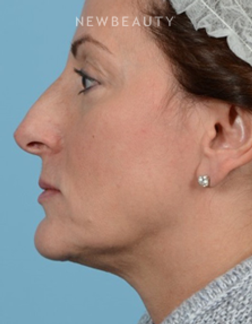 Dr. Jeffrey Wise - Rhinoplasty - Before