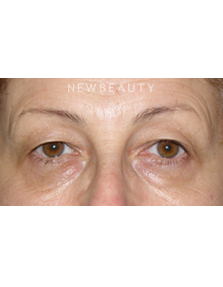 Dr. George Sanders - Eyelift - Before