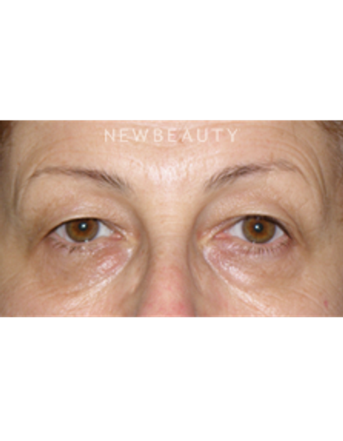 Dr. George Sanders - Eyelift - Before