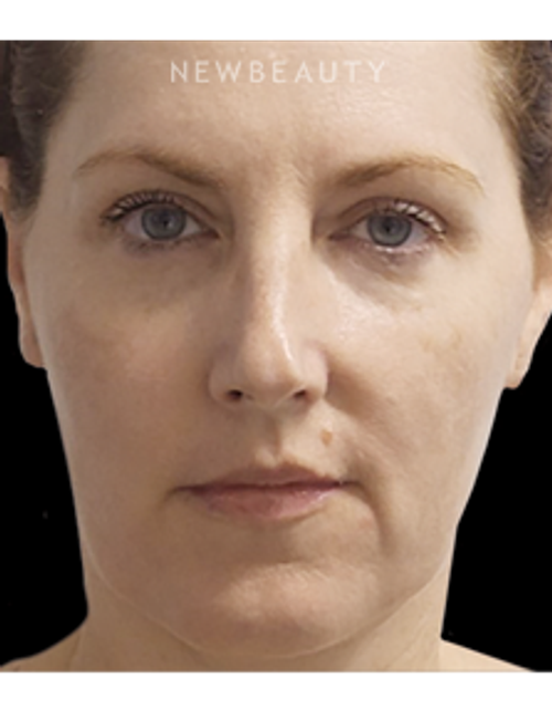 Dr. Marina Peredo - Nonsurgical Lifting and Tightening - After