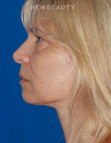 Dr. Konstantin Vasyukevich - Upper and Lower Blepharoplasties - Before