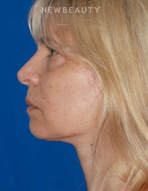 Dr. Konstantin Vasyukevich - Upper and Lower Blepharoplasties - Before
