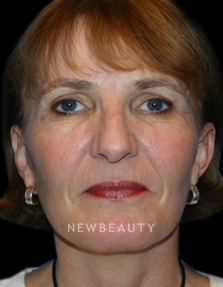Dr. Kelly Bomer Facelift, Necklift - After