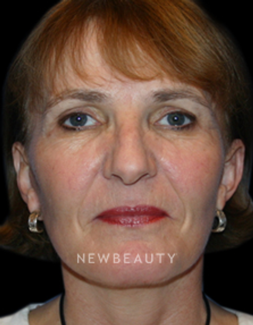 Dr. Kelly Bomer Facelift, Necklift - After
