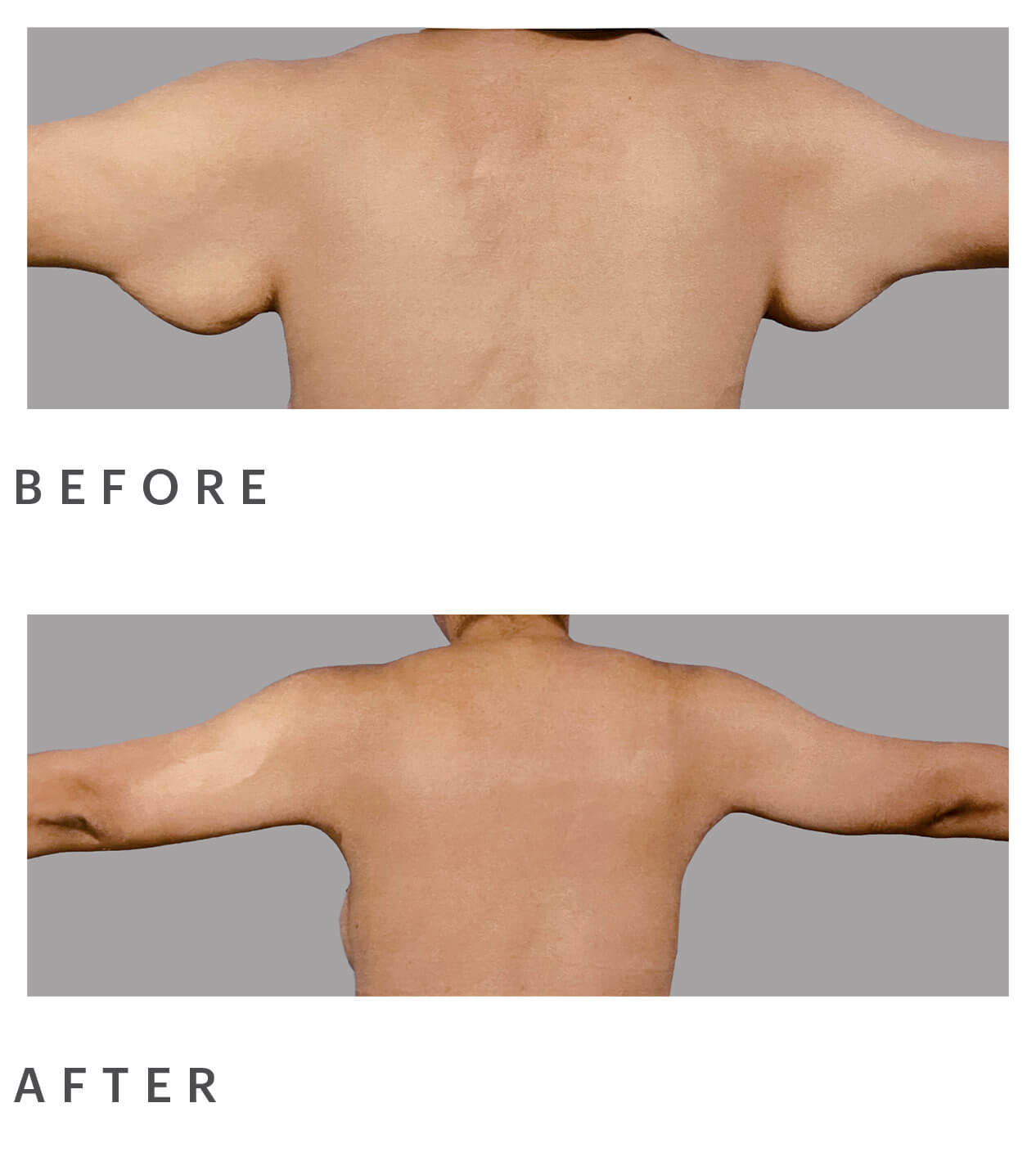 before and after arm lift