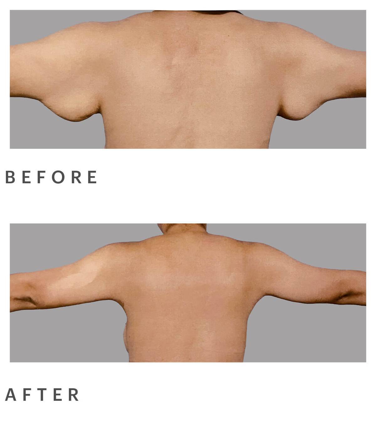 before and after arm lift