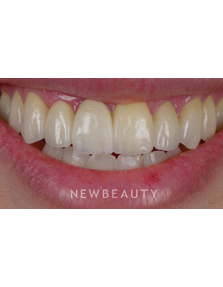 Dr. Husam Almunajed - Smile Makeover - Before