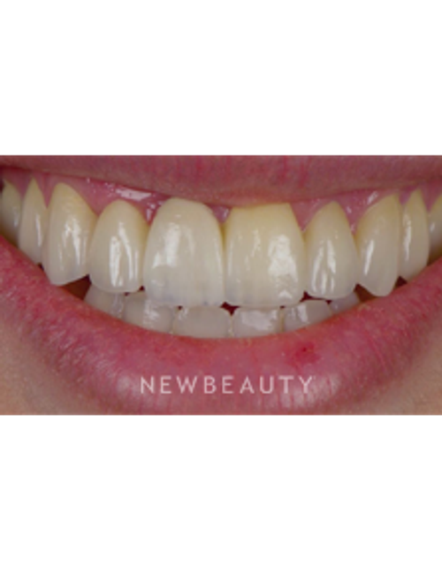 Dr. Husam Almunajed - Smile Makeover - Before