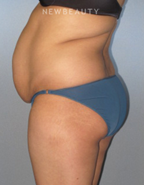 Dr. German Newall - Slimmer Profile - Before