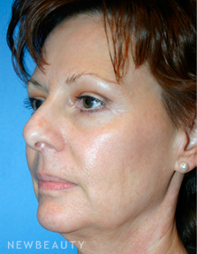 Dr. Kelly Bomer Liquid Facelift - Before