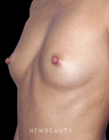 Dr. Sean Simon - Enhancing Volume - Before