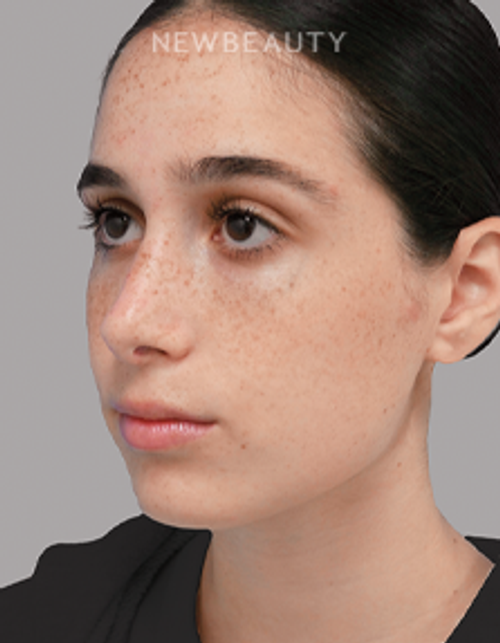 Dr. Michael A. Epstein - Natural-Looking Results - 33109401 - After