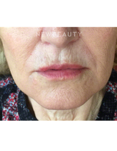 Dr. Kally Papantoniou - Injectables and Fillers - After