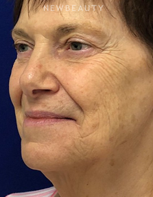 Dr. Dilip D. Madnani – Facelift - Before