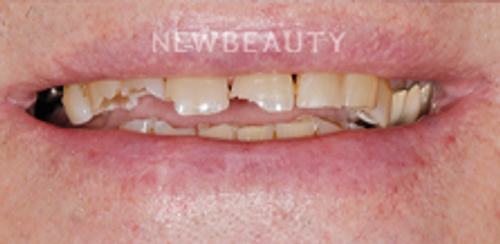 Dr. Salvator La Mastra - Smile Makeover -46107962 - Before