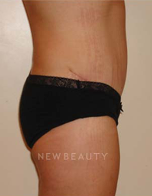 Dr. Michael Horn Tummy Tuck - After