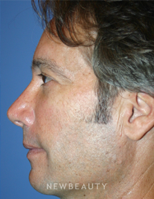 Dr. Kelly Bomer - Liquid Facelift - After