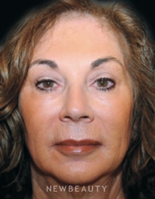 Dr. Janet Allenby Injectables & Fillers - After