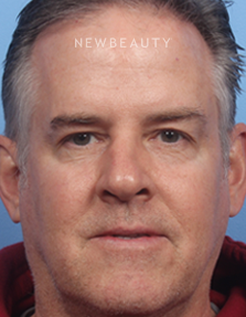 Dr. Kelly Bomer - Browlift - After