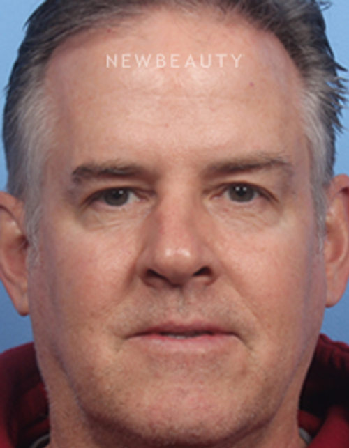 Dr. Kelly Bomer - Browlift - After