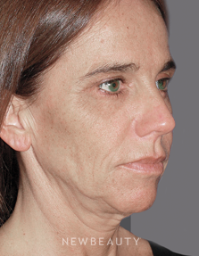 Dr. Konstantin Vasyukevich Facelift, Necklift - Before