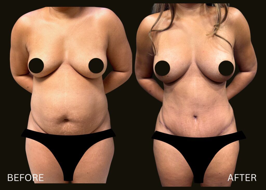 Mommy makeover before and after