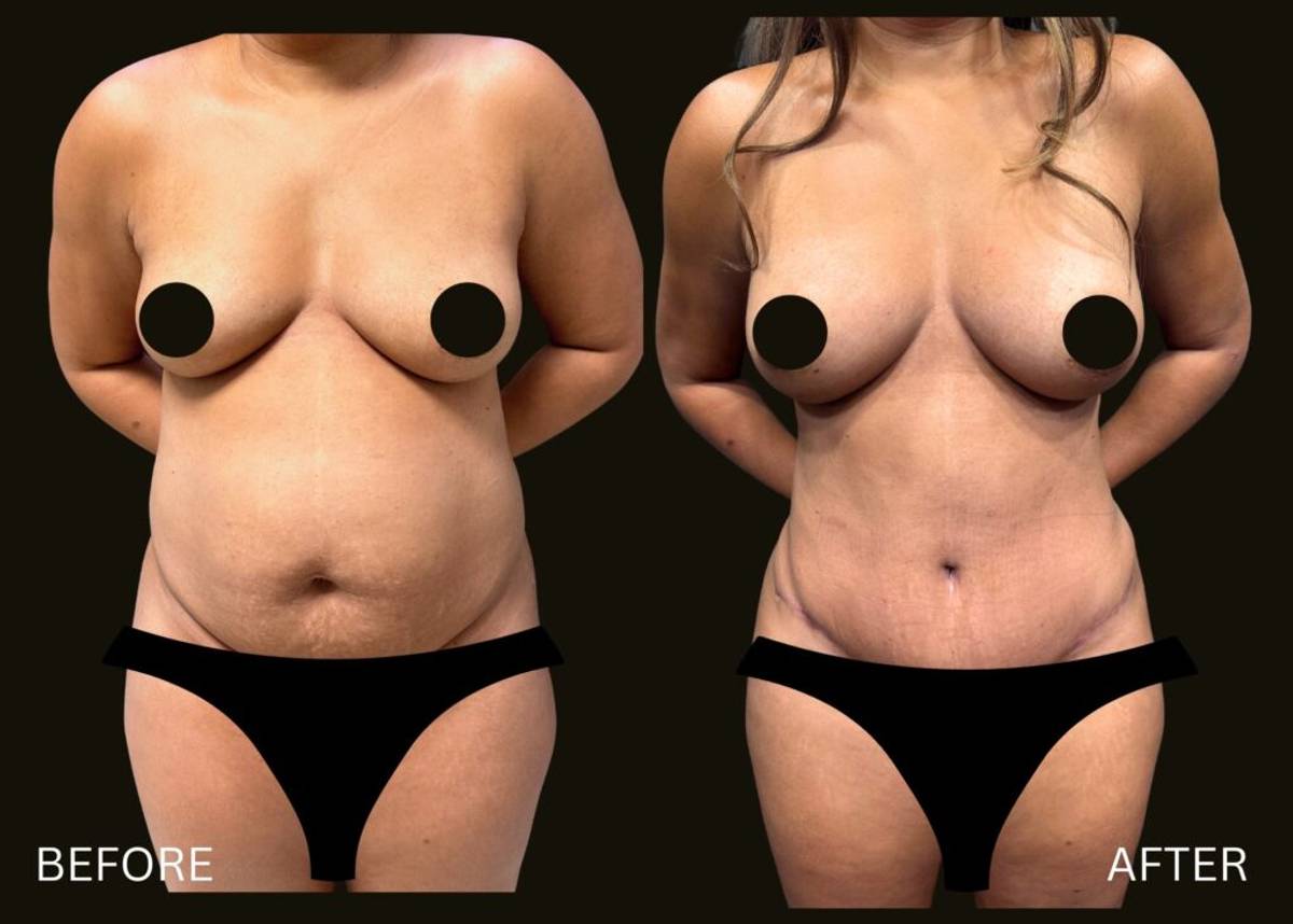 Mommy makeover before and after