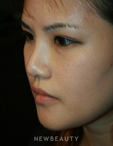 Dr. John Kang - Upper Blepharoplasty & Rhinoplasty - After