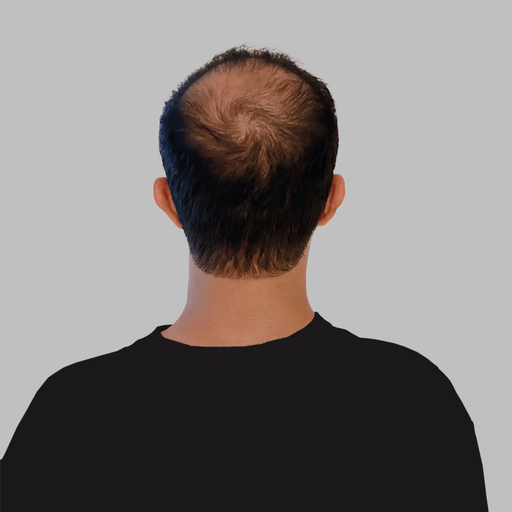 Before Follicular Unit Extraction (FUE) hair transplant