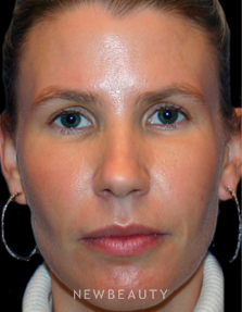 Dr. Kelly Bomer Liquid Facelift - After