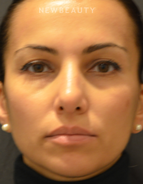 Dr. B. Aviva Preminger - Rhinoplasty - After