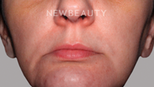 Dr. Elaine Kung - Skin Tone and Rosacea - 33036743 - Before