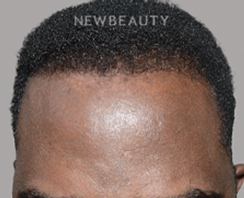 Dr. Jeffrey Epstein - Hair Transplant - 46167771 - After