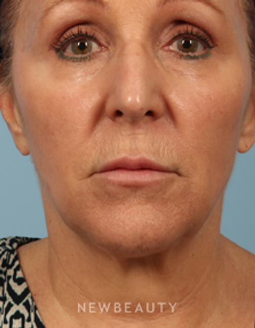 Dr. Carmen M. Kavali - Contour Correction - After