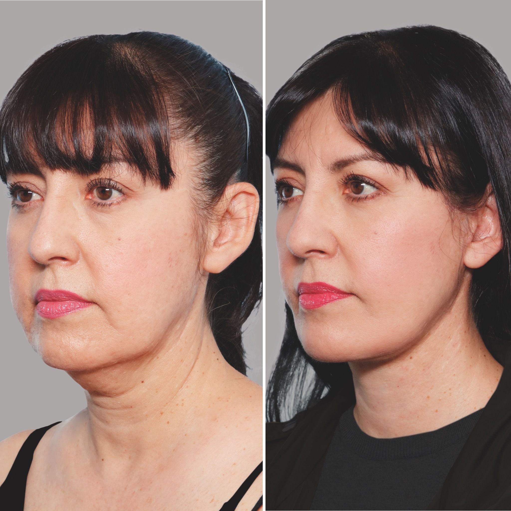 Newport Beach, CA plastic surgeon Jonathan Zelken, MD