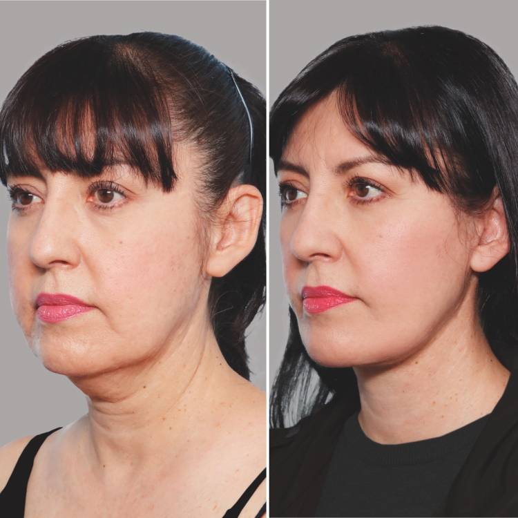 Newport Beach, CA plastic surgeon Jonathan Zelken, MD