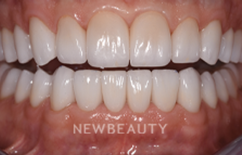 Dr. Sara Cummins - Smile Makeover - 14738055 - After