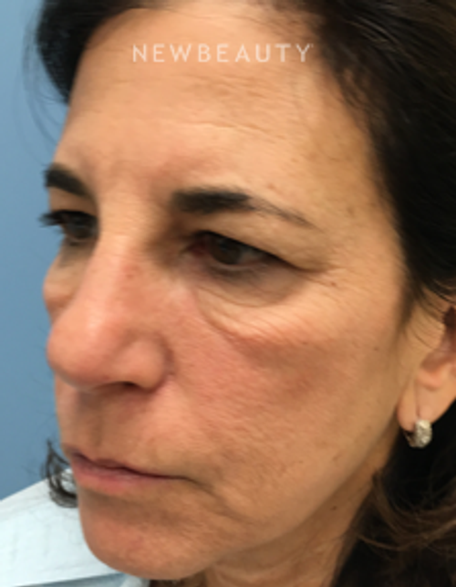 Dr. Mokhtar Asaadi - Blepharoplasties and Kybella - Before