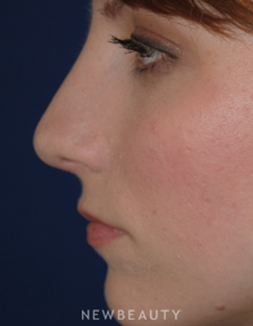 Dr. Lee Ann Klausner Rhinoplasty - After