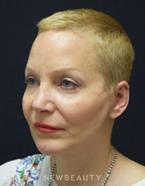 Dr. Jeffrey B. Wise - Facelift - After