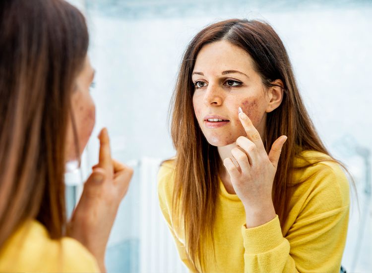 Don’t do a peel while on Accutane