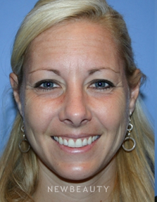 Dr. Kelly Bomer - Injectables & Fillers - Before