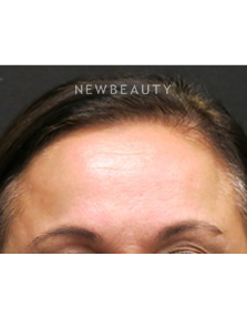 Dr. Jody Levine - Lasers - After